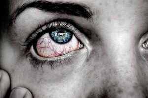sjogren